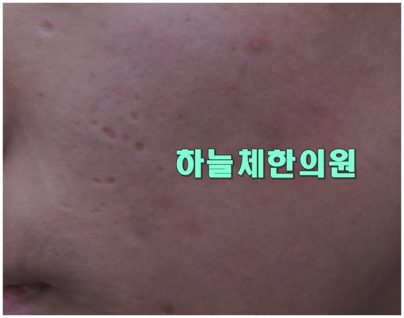 대전수두흉터 새살침 치료, 오래된 패인 자국도 관리할 수 있을까요?