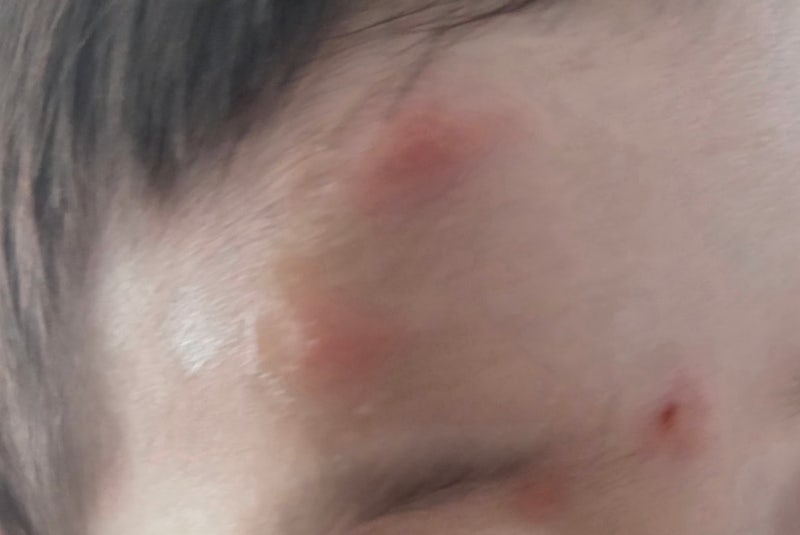 아기 모기 물림 대응법 (연고, 가려움 완화, 진물 케어, 착색 관리, 병원 가야 하는 경우) 총정....