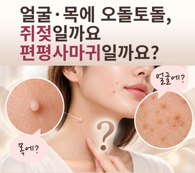 얼굴, 목에 오돌토돌, 쥐젖일까요 편평사마귀일까요? 차이점 구별하기