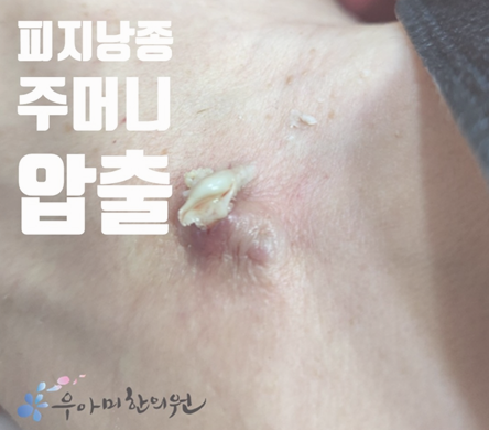 사타구니 피지낭종, 걷고 앉을 때 통증이 커지는 구조