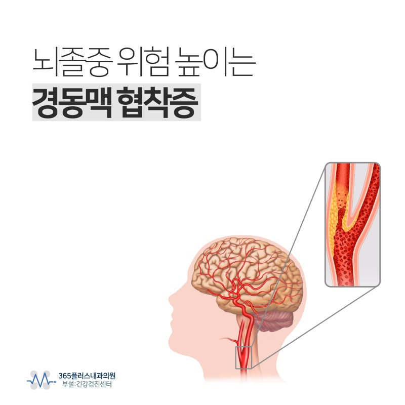 미사경동맥초음파, 뇌졸중 위험 높이는 경동맥 협착증