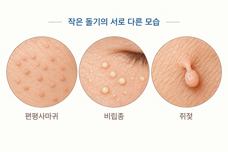 과천 갈현동피부과, 편평사마귀 비립종 쥐젖은 어떻게 제거해야 하나요?