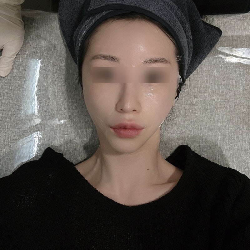 써마지vs세르프 수성구 피부과 세르프리프팅 잘하는 곳 대구 울쎄라 대구 써마지