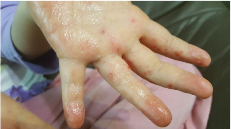 손가락에 작은 물집이 반복된다면? 한포진 증상과 관리 기준