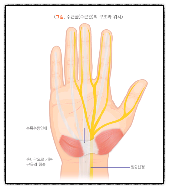 "밤마다 손이 저려 깨신대요?" 현직 간호사가 알려주는 손목터널증후군 탈출 꿀팁 (정중신경)
