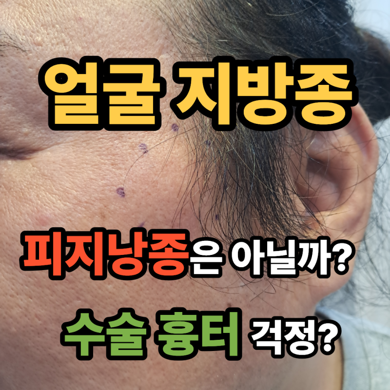 얼굴 지방종, 피지낭종은 아닐까? 수술 흉터 걱정된다면?