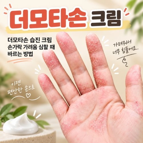 더모타손 습진 크림 손가락 가려움 심할 때 바르는 방법