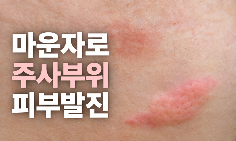 마운자로 주사부위 피부발진,붓고 가려운 부작용 직접 겪은 후기
