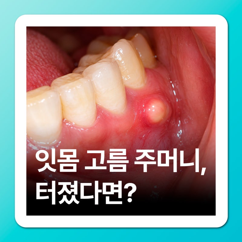 잇몸 고름 주머니, 물집 터졌을 때 대처방법