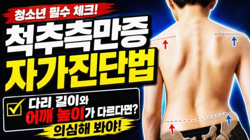 청소년 척추측만증 자가진단법, 다리 길이와 어깨 높이가 다르다면 의심해 봐야