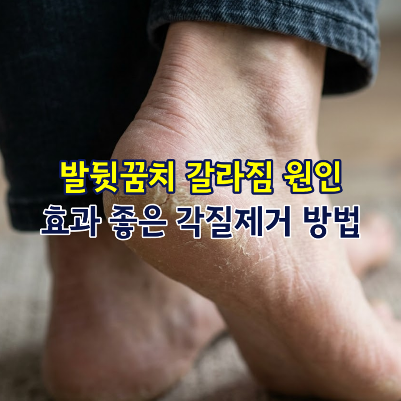 발뒷꿈치 갈라짐 원인, 효과 좋은 각질제거 방법