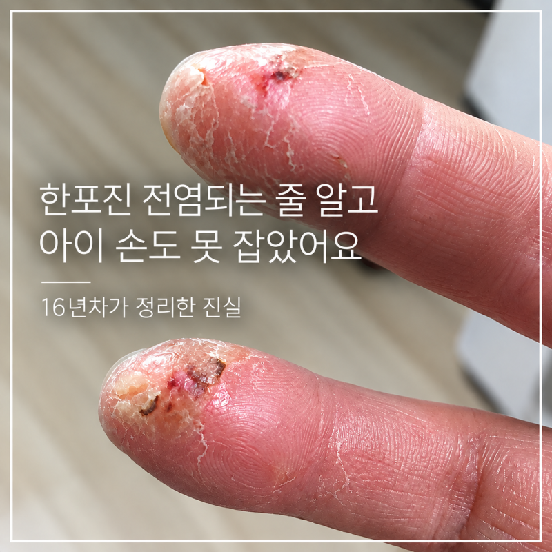 한포진 전염되는 줄 알고 아이 손도 못 잡았어요｜16년차가 정리한 진실