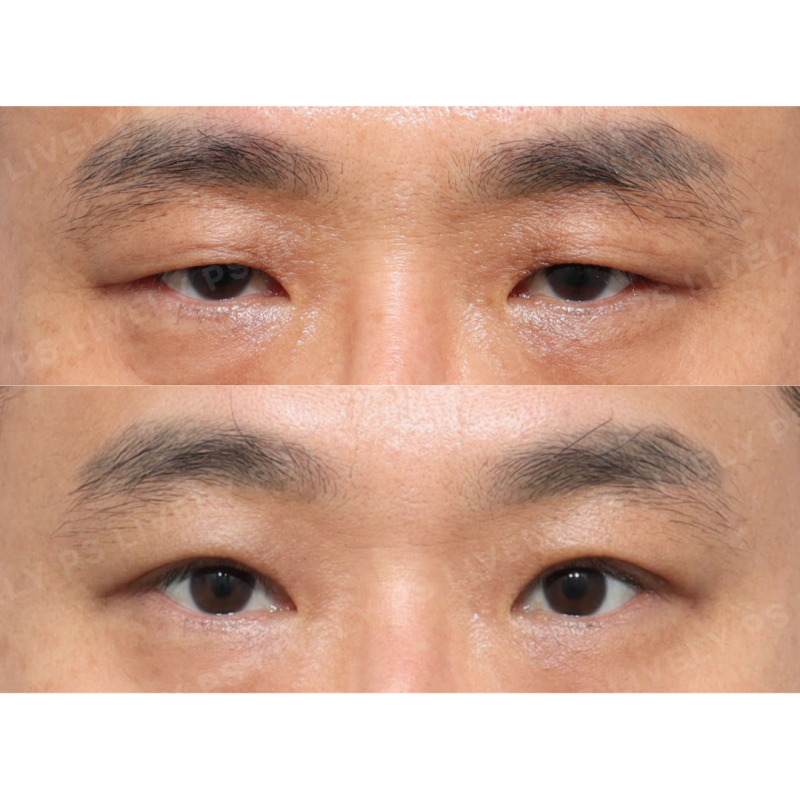 안검하수 증상, 원인, 수술 방법까지 이 글 하나로 정리하세요