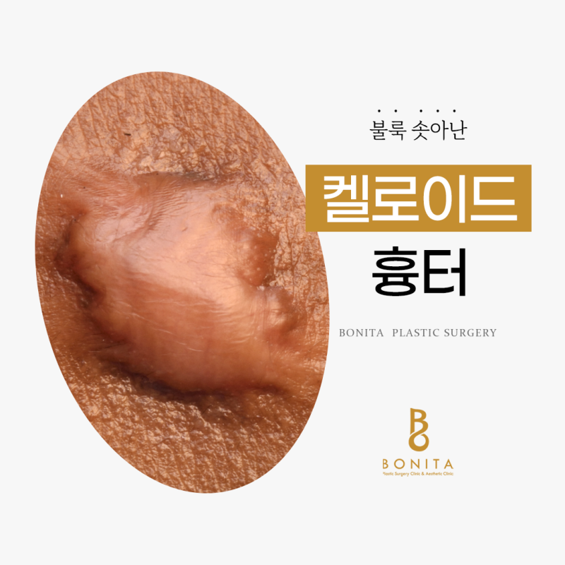 수술 자국이 부풀어 오른다면 켈로이드 흉터일까 비후성반흔일까