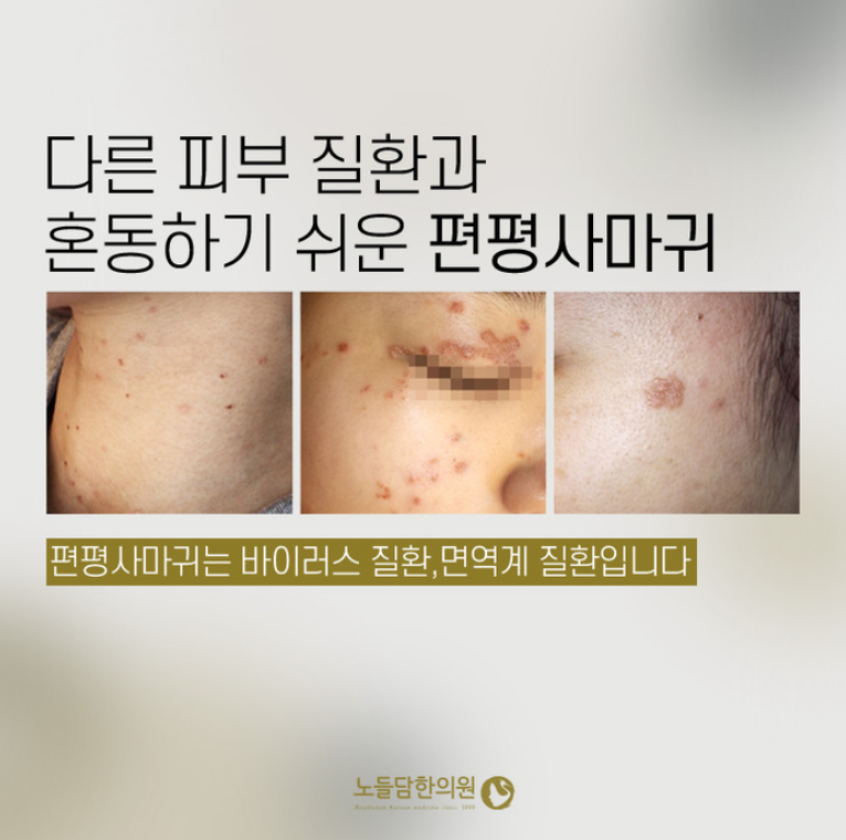 재발하는 편평사마귀 원인 내 몸속에 있었다