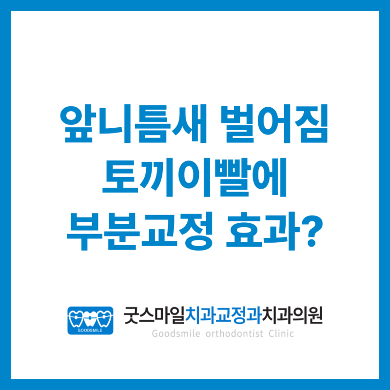앞니틈새 벌어짐, 토끼이빨 등 부분교정으로 효과있을까?