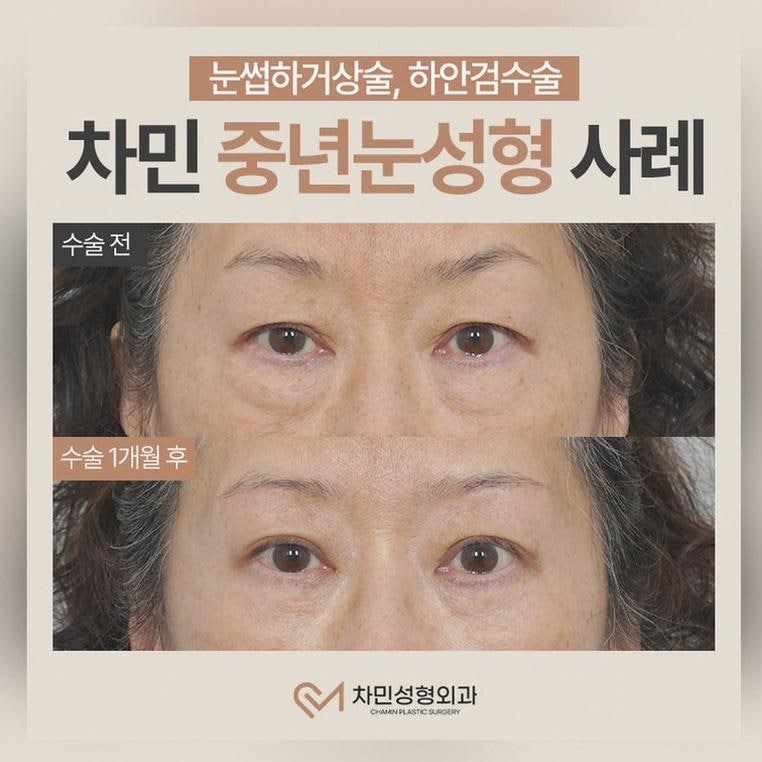 눈썹하거상 수술 방법 효과 회복기간 부작용 정보