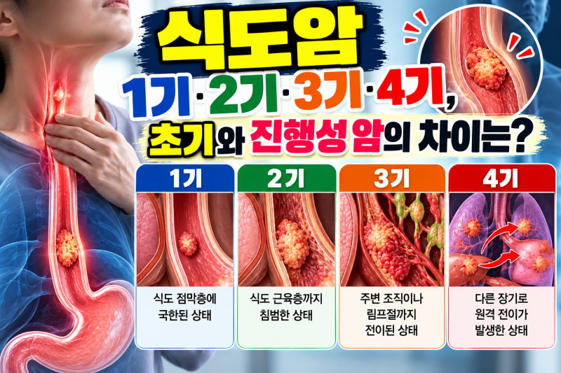 식도암 1기·2기·3기·4기, 초기와 진행성 암의 차이는?
