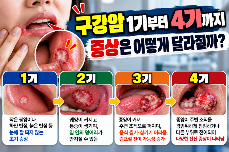 구강암 1기부터 4기까지 증상은 어떻게 달라질까?