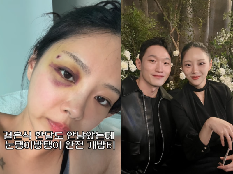 김슬기, 결혼 앞두고 ‘멍든 눈’ 사진 해명…“유현철에게 맞은 것 아냐, 화장실서 넘어져....
