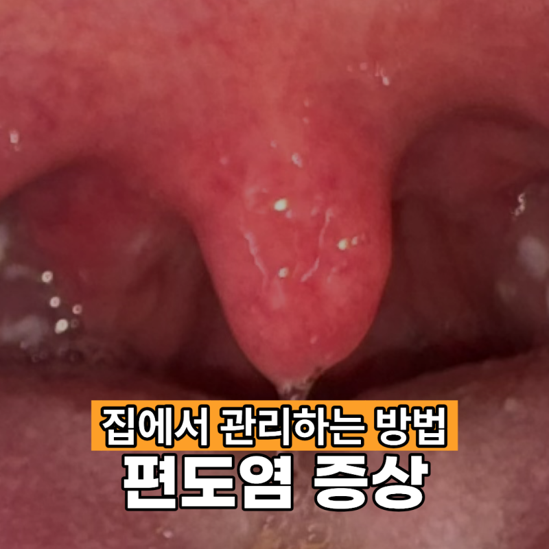 편도염 증상 집에서 관리하는 법