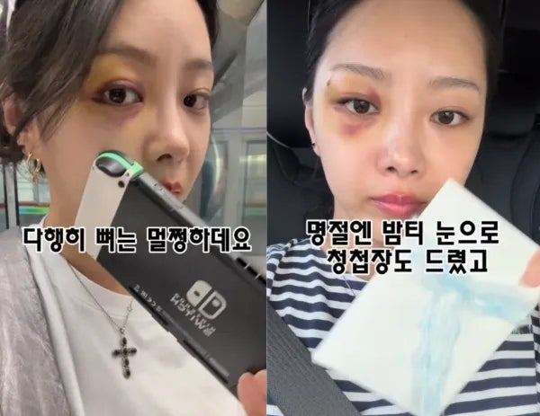 나는솔로 10기 옥순 김슬기, 결혼 앞두고 눈 피멍…“유현철에게 맞은 것 아냐” 직접 해명