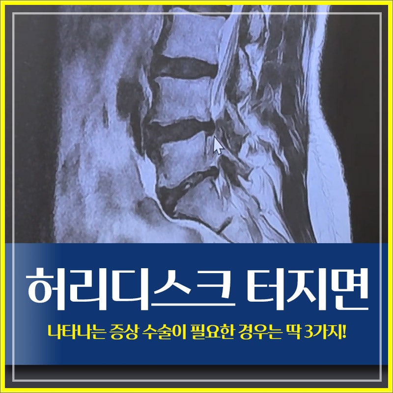 허리디스크 터지면 나타나는 증상 수술이 필요한 경우는 딱 3가지!