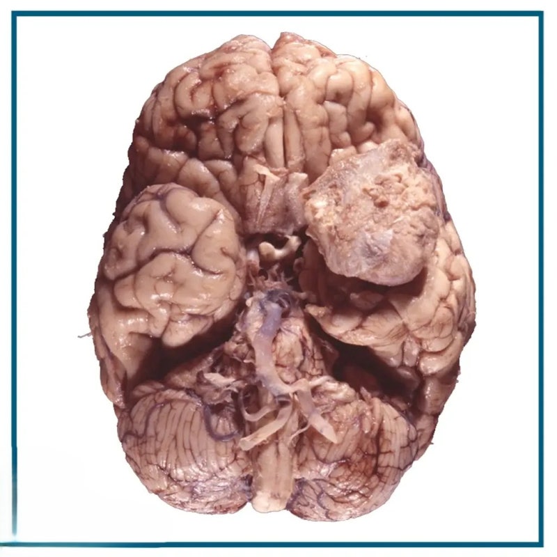 뇌종양 Brain tumor: 인간은 어떻게 ‘뇌 속의 낯선 존재’를 이해하게 되었을까요?