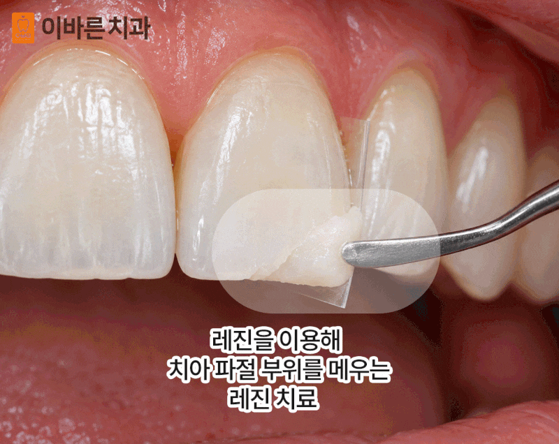 순천치과추천 레진 치료는 어떤 경우에 사용할까요?