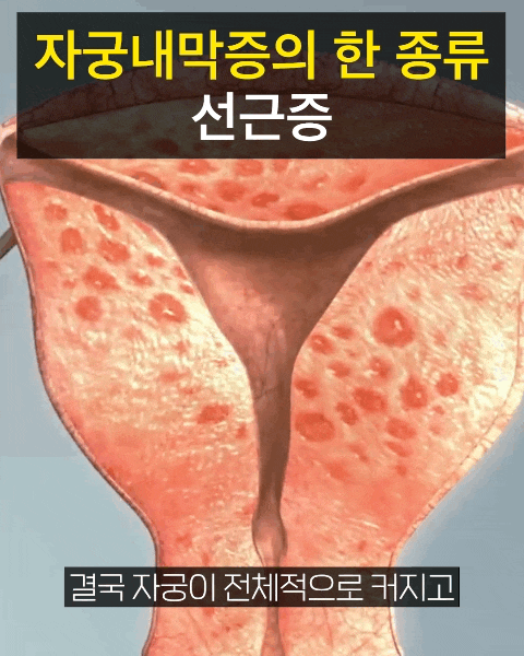 [전문의 자문] 자궁근종 VS 자궁선근증 정의/증상/치료/적출
