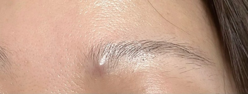 모기질종 제거 수술 후기 / 피지낭종 (1탄)