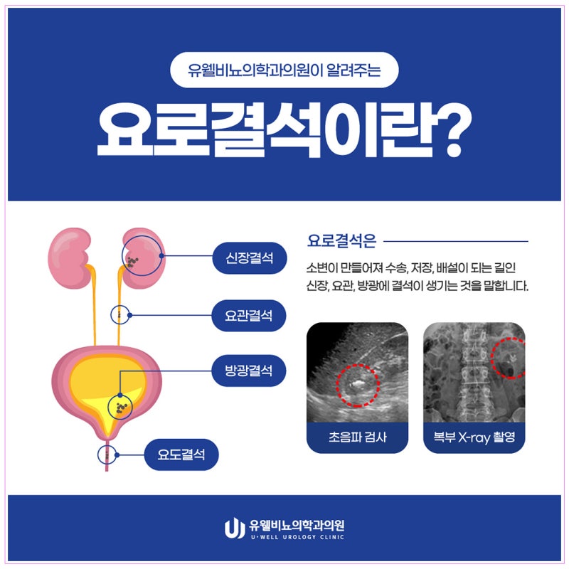 신장결석치료 시기 및 자메닉스 치료과정 정리