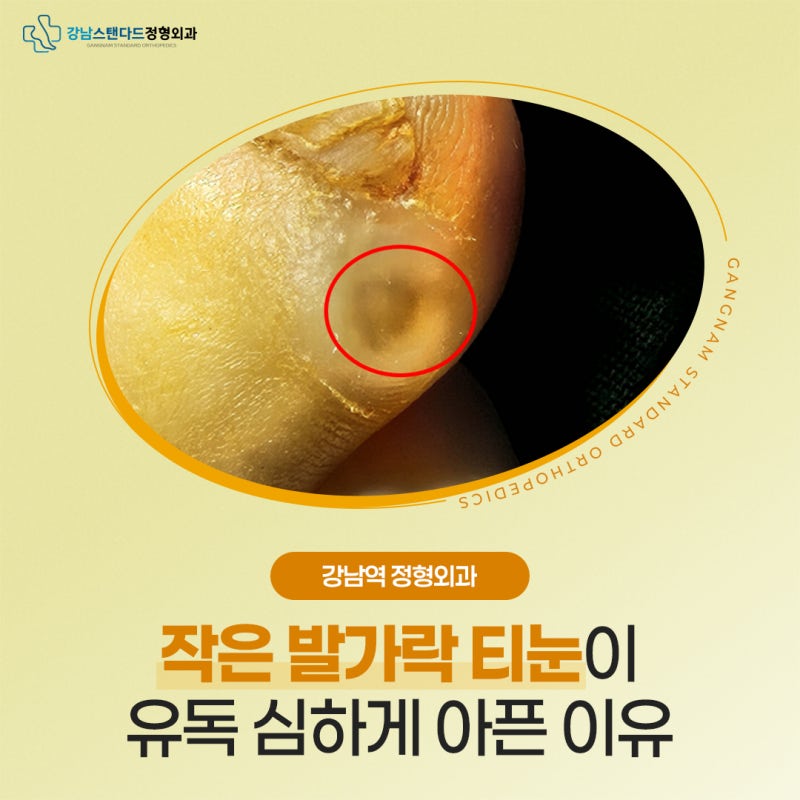 강남역 정형외과, 작은 발가락 티눈이 유독 심하게 아픈 이유