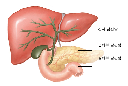 담낭암