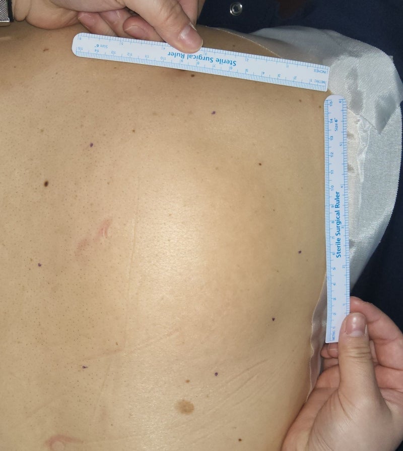 부산 등 거대 지방종(근육밑 지방종), 큰 지방종도 작은 절개로 수술할 수 있나요? - 위아더성....