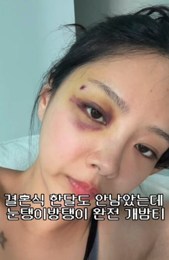 "남편한테 맞았냐고요?" 10기 옥순, 결혼식 앞두고 번진 '시퍼런 멍' 의혹에 직접 밝힌 진짜 이....