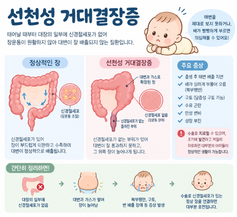 "신생아 배가 빵빵하고 태변을 못 본다면?" '선천성 거대결장증'의 원인, 증상, 종류, 유전, 진....