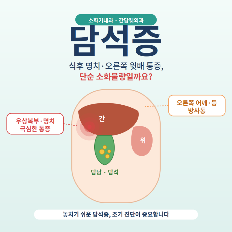 담석증, 무조건 수술해야 할까? 증상부터 치료까지 전문의가 설명드립니다