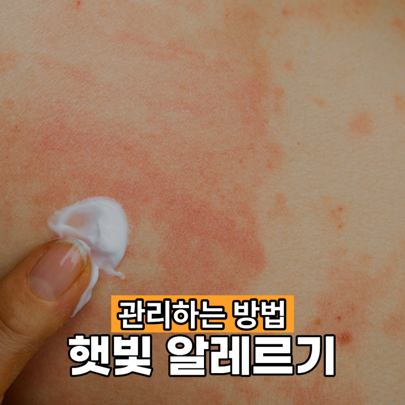 햇빛 알레르기 관리하는 방법은?