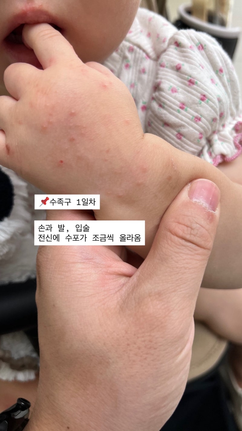 아기 수족구 수포 과정(17개월)