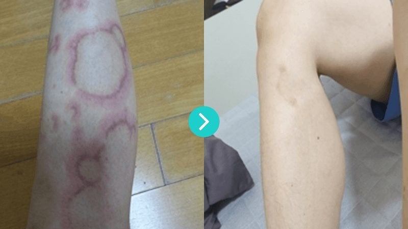 동그란습진과 피부진물, 동전 모양으로 번지는 이유