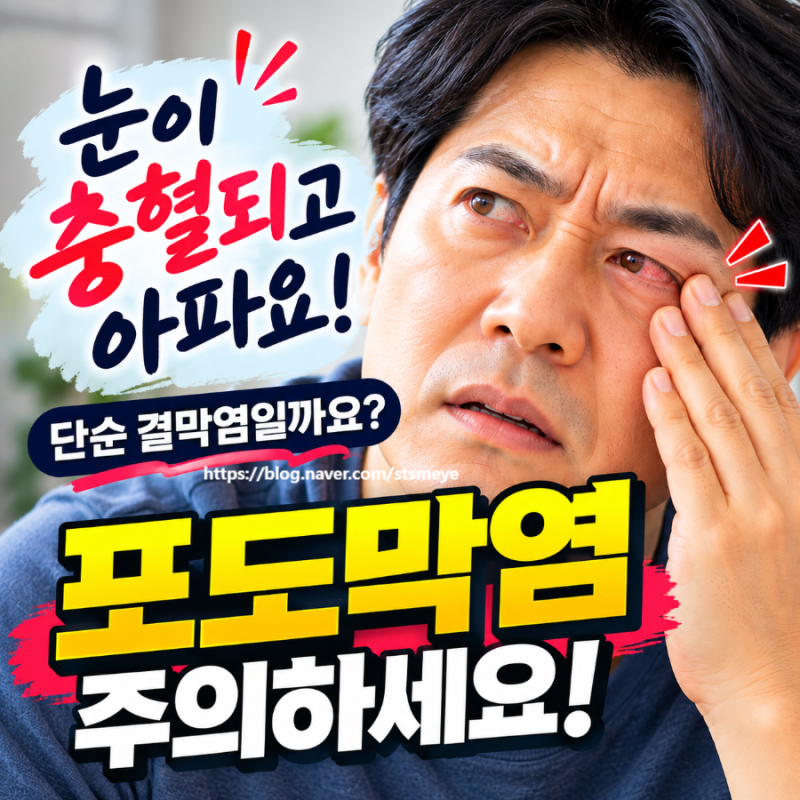 송탄안과 포도막염, 눈이 충혈되고 아픈데 결막염일까요? 눈부심·눈 통증·시야 흐림·비문....