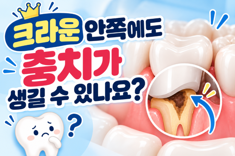 크라운 안쪽에도 충치가 생길 수 있나요?