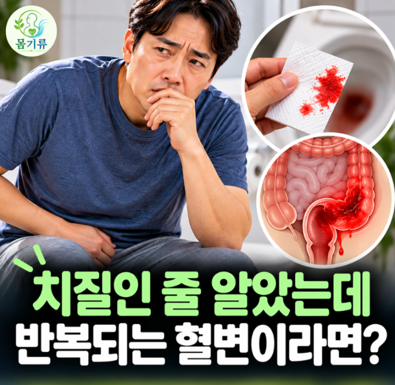 “치질인 줄 알고 넘겼는데…” 화장실에서 또 피가 보였다, 혈변 언제 대장암을 의심해야 ....