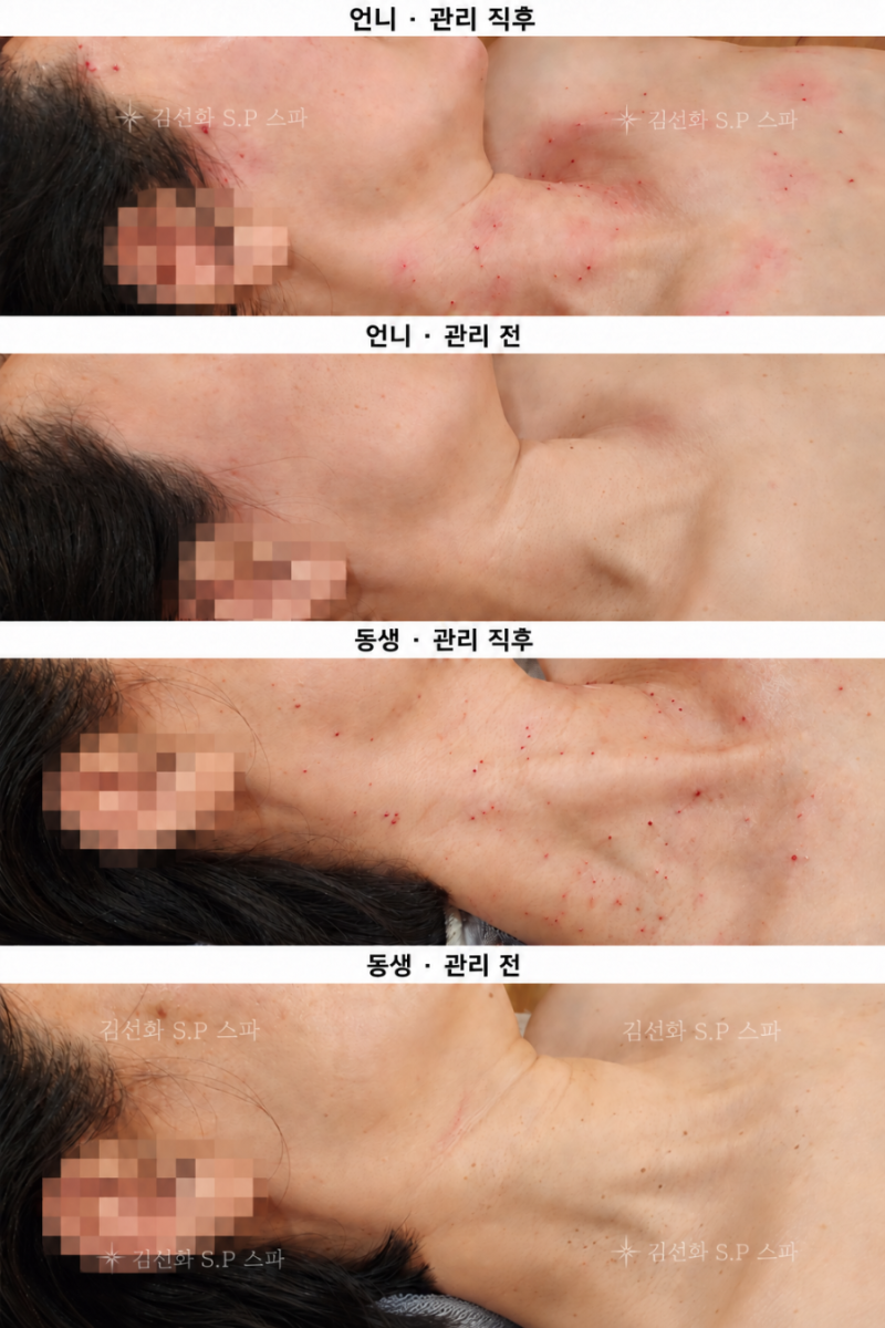 세종 실면도 쥐젖·편평사마귀 관리, 출산 후 고민으로 방문한 쌍둥이 자매