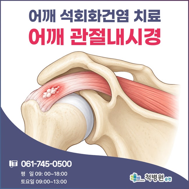 밤잠 설치게 하는 어깨 야간통, 방치하면 안되는 이유_석회화건염 원인과 치료법ㅣ순천 어깨....