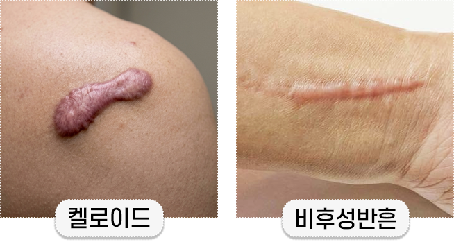 튀어나온 흉터가 모두 켈로이드는 아닙니다, 대구비후성반흔 구분법