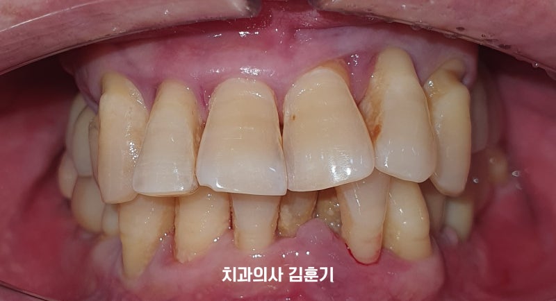 잇몸뼈가 많이 녹은 앞니 임플란트 치료과정