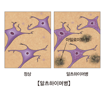 알츠하이머