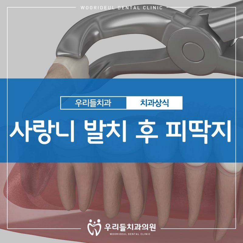 사랑니발치 후 생긴 피딱지, 그대로 두어야 하는 이유